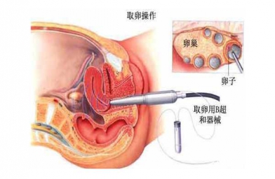 “二孩政策”致浙江试管婴儿激增，但费用和成功率不成正比